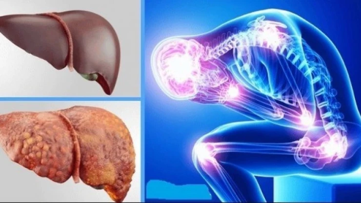 Karaciğer nakilleri arttı, hastalık önlenebilir