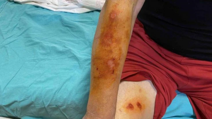 Lavabo açıcı bomba gibi patladı, soluğu hastanede aldı